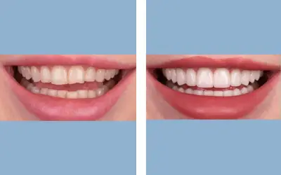 Before and After